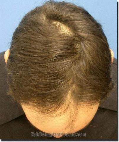 Hair restoration procedure results