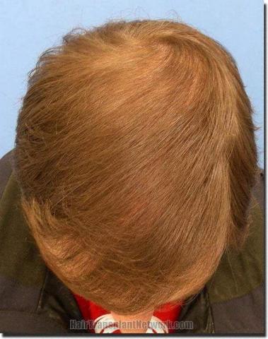 Hair restoration procedure results