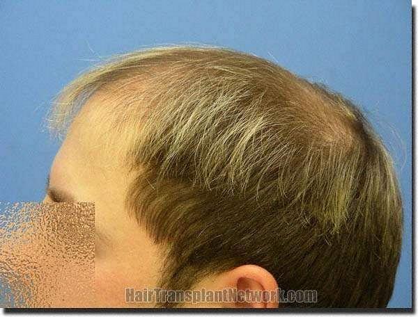 Hair restoration procedure results