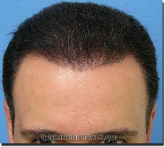 Hair restoration procedure results