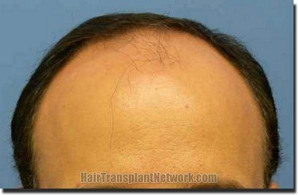 Hair restoration procedure results