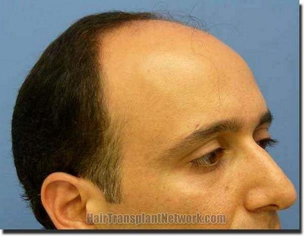 Hair restoration procedure results