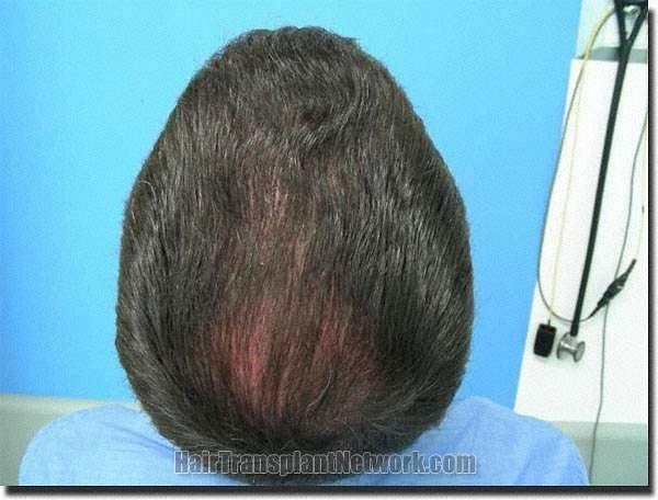 Hair restoration procedure results