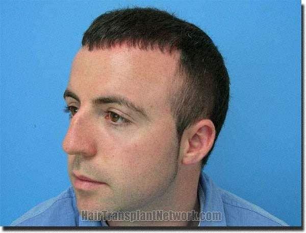 Hair restoration procedure results