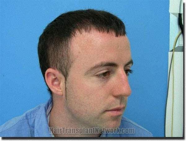 Hair restoration procedure results