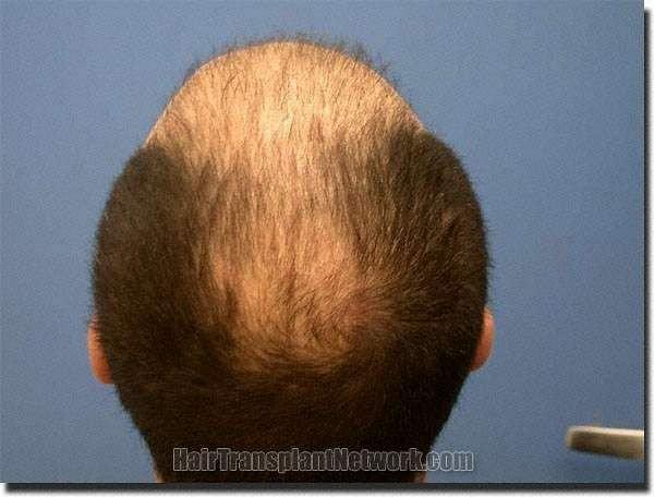 Hair restoration procedure results