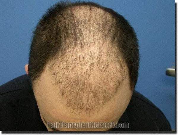 Hair restoration procedure results