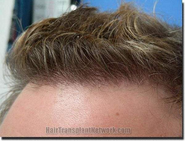 Hair restoration procedure results