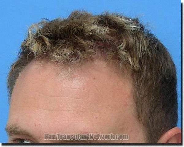 Hair restoration procedure results