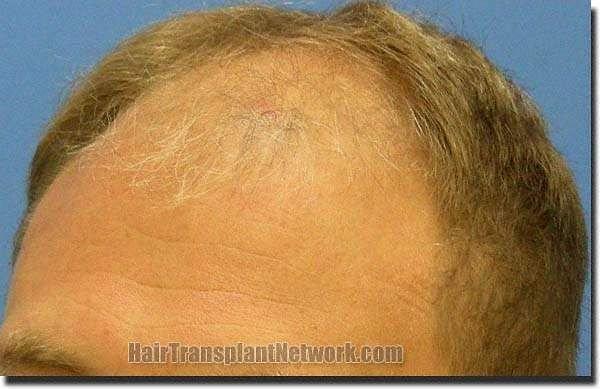 Hair restoration procedure results