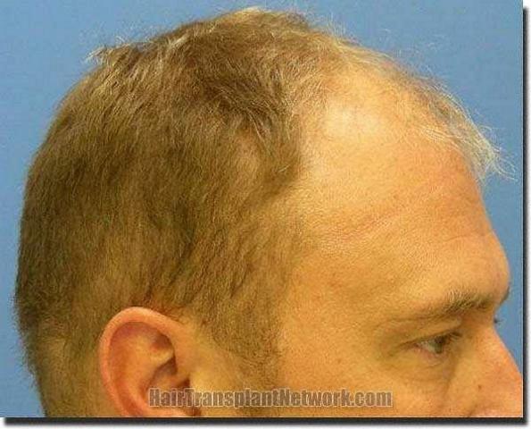 Hair restoration procedure results