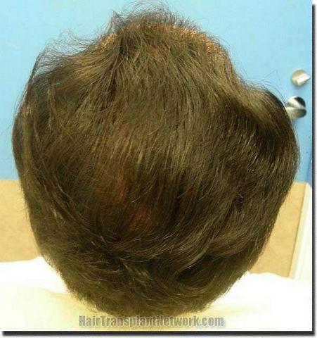 Hair restoration procedure results