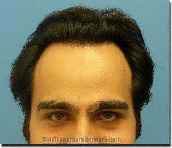 Hair restoration procedure results