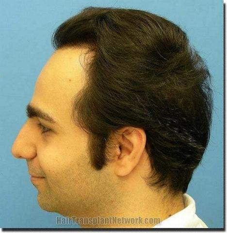 Hair restoration procedure results