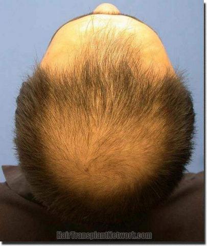 Hair restoration procedure results