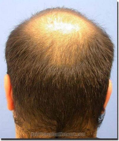 Hair restoration procedure results