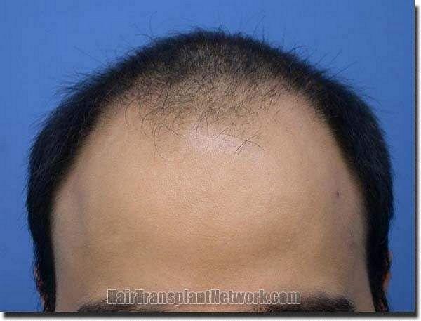 Hair restoration procedure results