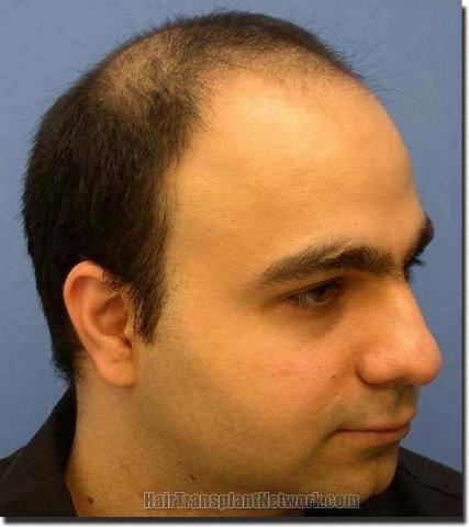 Hair restoration procedure results