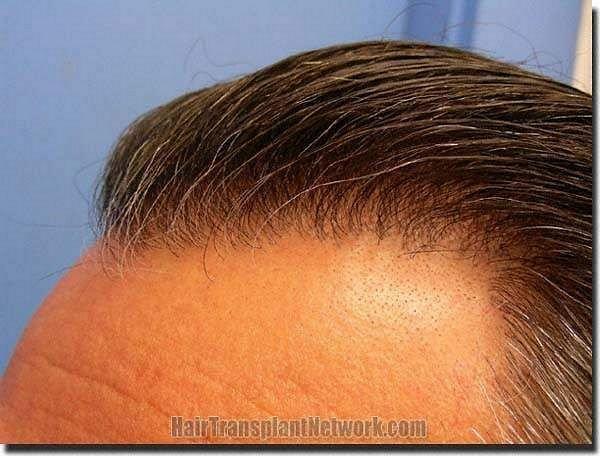 Hair restoration procedure results