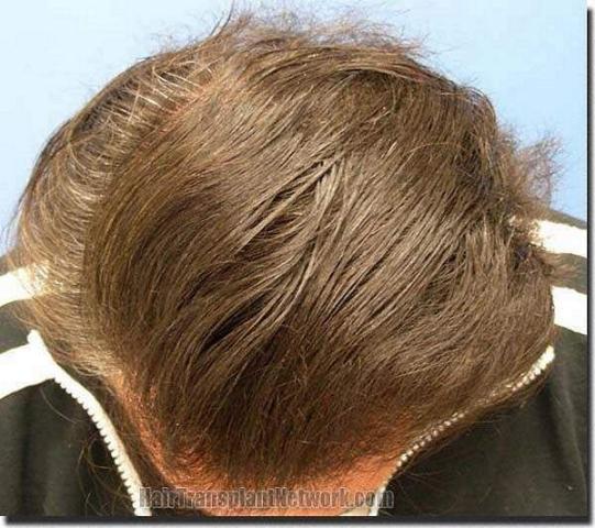 Hair restoration procedure results