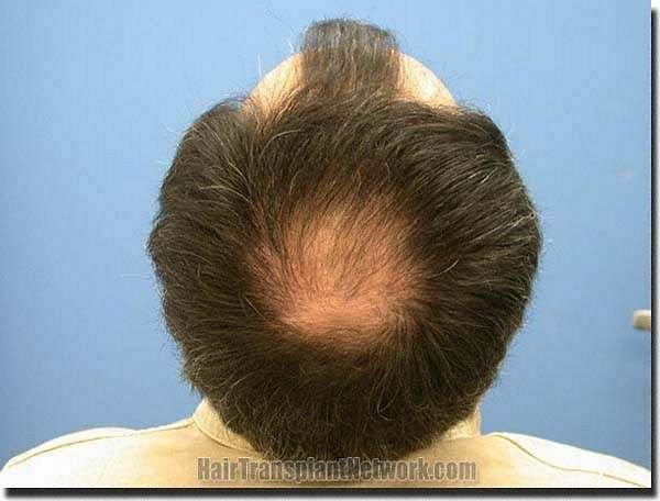 Hair restoration procedure results