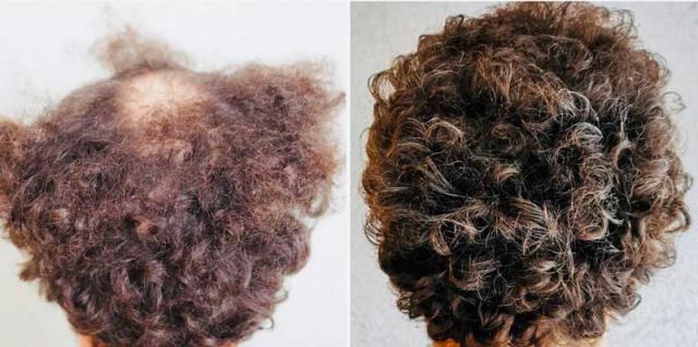 Before after FUE 4300 grafts, back of head
