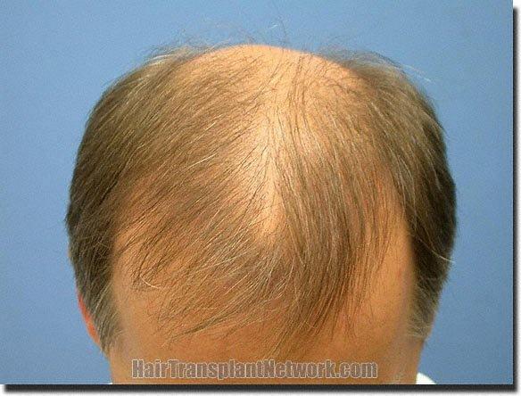 Hair restoration procedure results