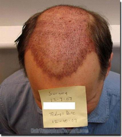 Hair restoration procedure results