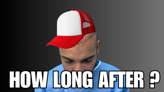 How Long After Hair Transplant Can I Wear A Hat