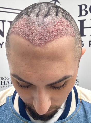 What Questions Should You Ask Before Getting A Hair Transplant