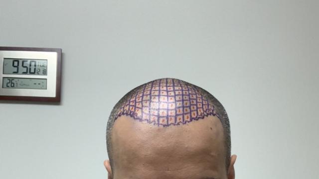 Hairline Mapped 