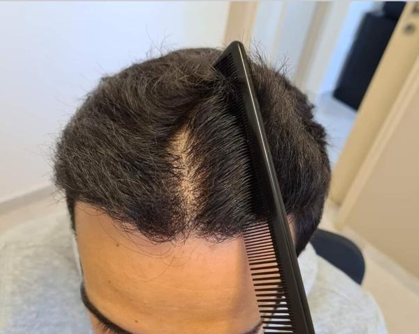 Comb through hairline
