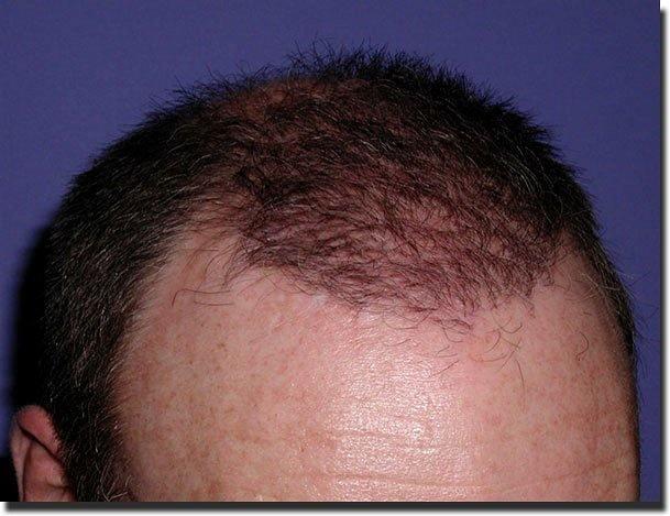 Hair restoration procedure results