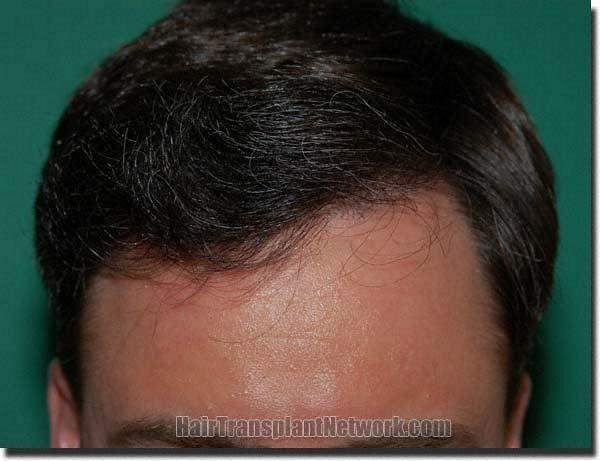 Hair restoration procedure results