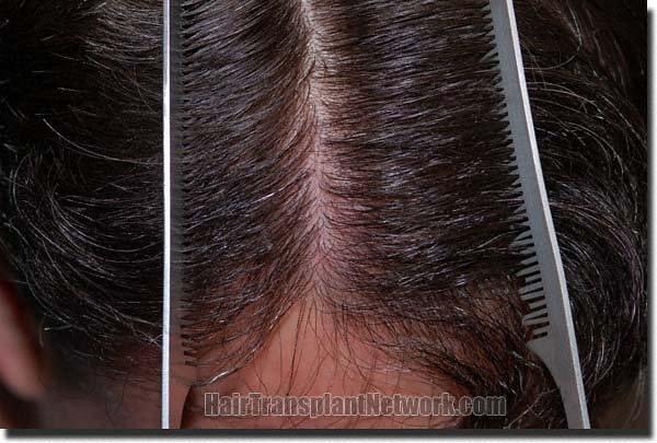 Hair restoration procedure results