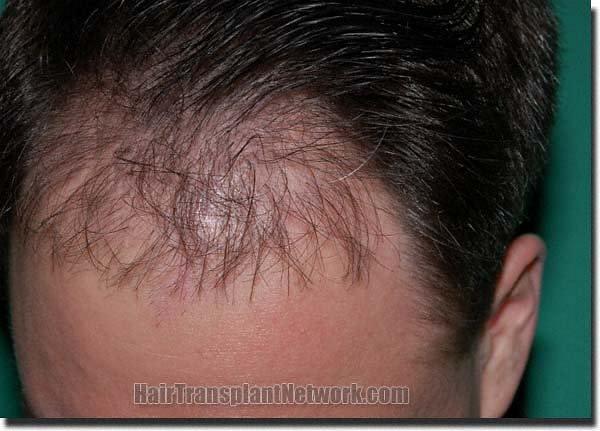 Hair restoration procedure results