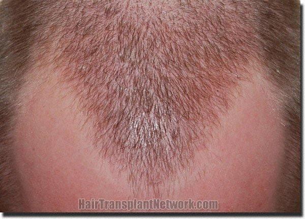 Hair restoration procedure results