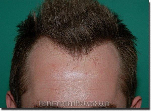 Hair restoration procedure results