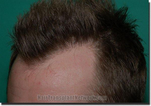 Hair restoration procedure results