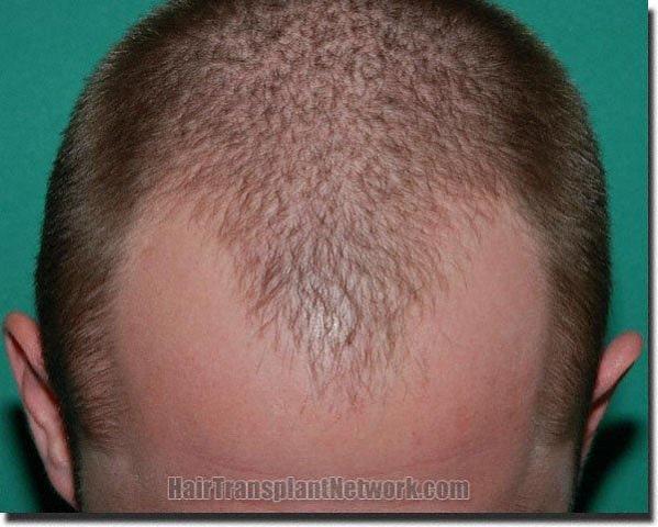 Hair restoration procedure results