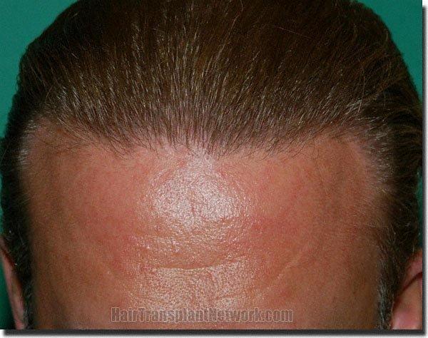 Hair restoration procedure results