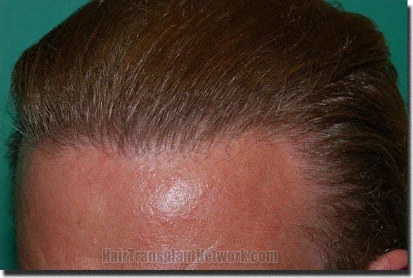 Hair restoration procedure results