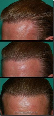 Hair restoration procedure results