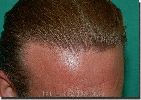 Hair restoration procedure results