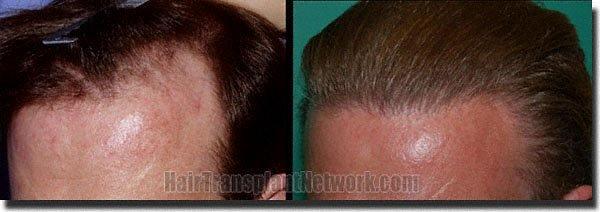 Hair restoration procedure results