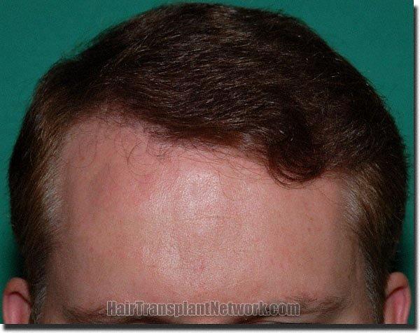 Hair restoration procedure results