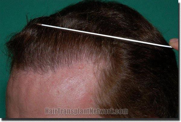 Hair restoration procedure results