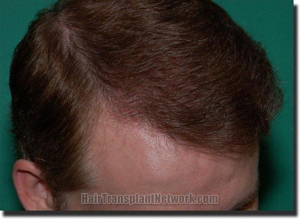 Hair restoration procedure results