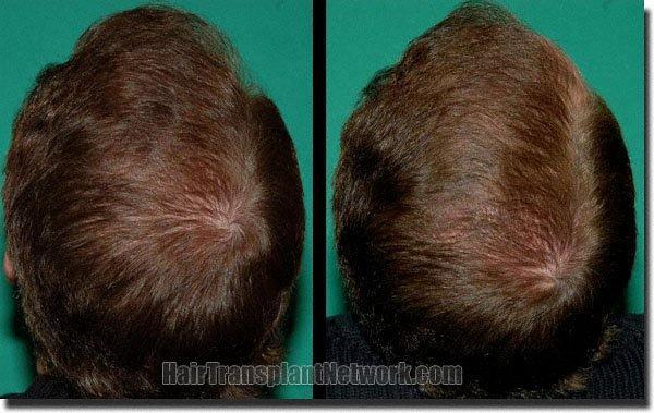 Hair restoration procedure results