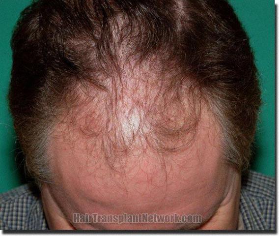 Hair restoration procedure results